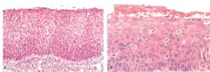 Carcinoma In Situ Bald Mountain Science