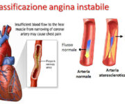angina-pectoris-angina-stabile-ed-instabile