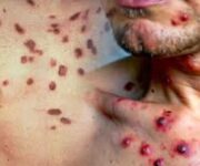 il-sarcoma-di-kaposi-clinica-diagnosi-e-terapia