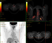 lutilizzo-della-pet-ct-con-fdg-in-oncologia