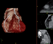 TC multistrato e ricostruzione tridimensionale che mostra la permeabilità dei bypass aorto-coronarici