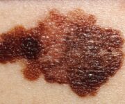 melanoma