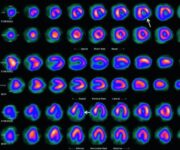 Ischemia della parete infero-laterale