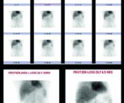 Studio scintigrafico della perdita proteica nell'Enteropatia Perdente Proteine (PLE) Perdita di proteine