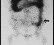 Studio con In-111 WBC che mostra un significativo uptake nel colon, indice di malattia attiva